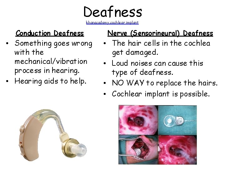 Deafness khanacademy. cochlear implant Conduction Deafness Nerve (Sensorineural) Deafness • Something goes wrong with