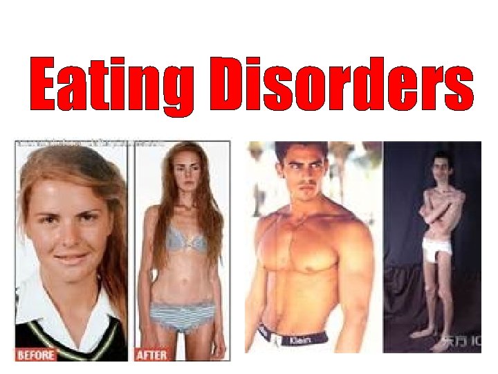 Eating Disorders 