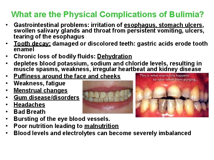 What are the Physical Complications of Bulimia? • Gastrointestinal problems: irritation of esophagus, stomach