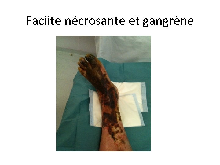 Faciite nécrosante et gangrène 