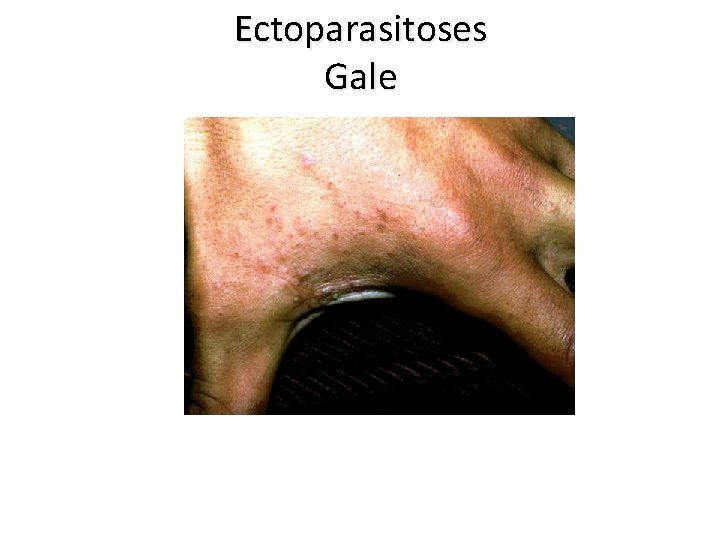 Ectoparasitoses Gale 
