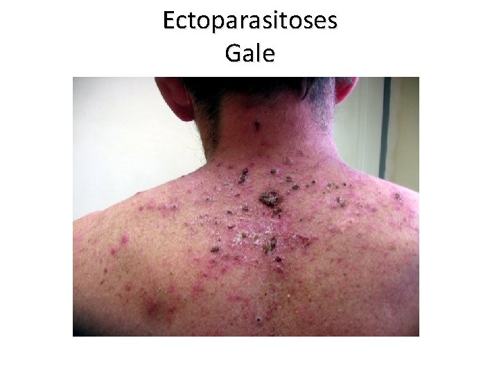 Ectoparasitoses Gale 