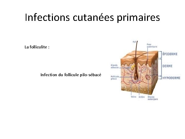 Infections cutanées primaires La folliculite : Infection du follicule pilo-sébacé 