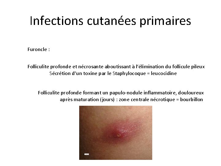 Infections cutanées primaires Furoncle : Folliculite profonde et nécrosante aboutissant à l’élimination du follicule