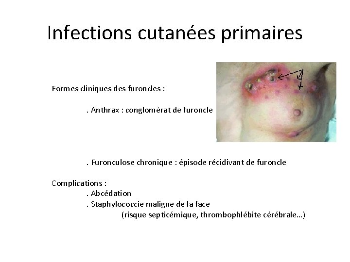 Infections cutanées primaires Formes cliniques des furoncles : . Anthrax : conglomérat de furoncle