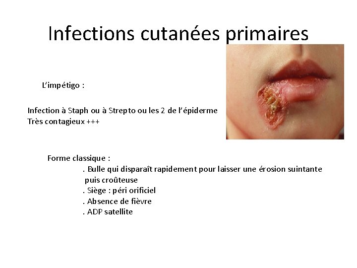 Infections cutanées primaires L’impétigo : Infection à Staph ou à Strepto ou les 2