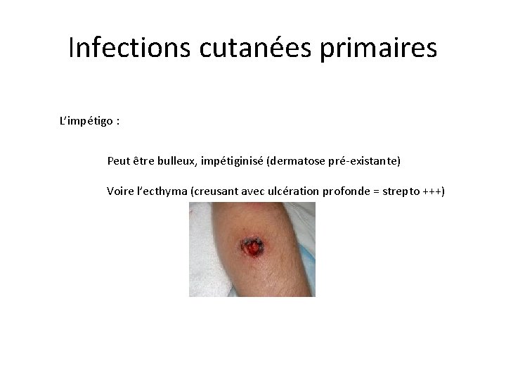 Infections cutanées primaires L’impétigo : Peut être bulleux, impétiginisé (dermatose pré-existante) Voire l’ecthyma (creusant