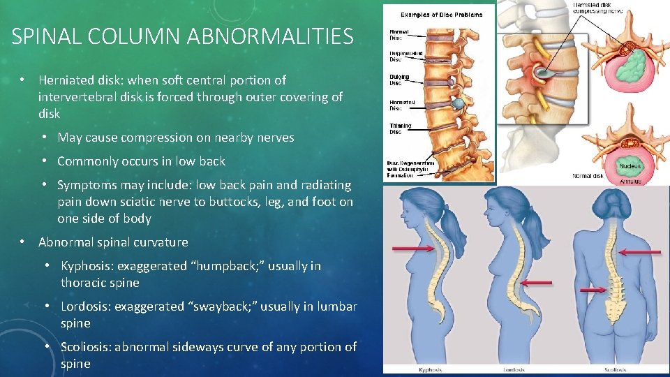 SPINAL COLUMN ABNORMALITIES • Herniated disk: when soft central portion of intervertebral disk is