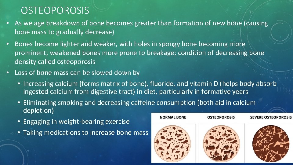 OSTEOPOROSIS • As we age breakdown of bone becomes greater than formation of new