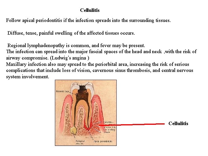 Cellulitis Follow apical periodontitis if the infection spreads into the surrounding tissues. Diffuse, tense,