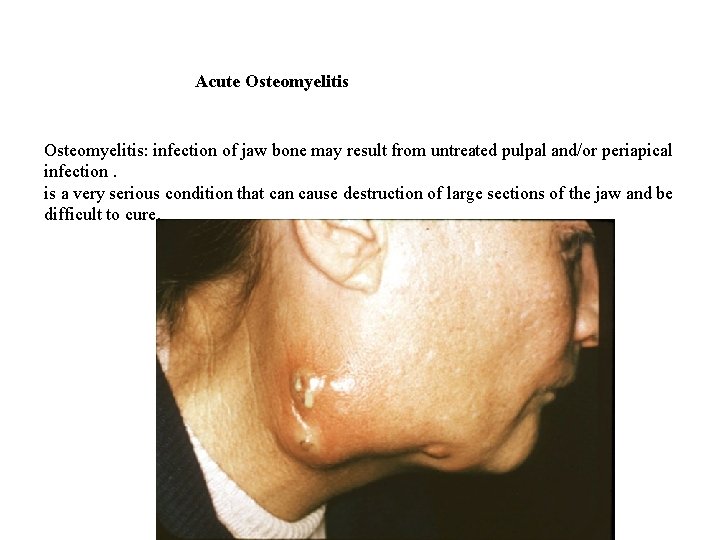 Acute Osteomyelitis: infection of jaw bone may result from untreated pulpal and/or periapical infection.