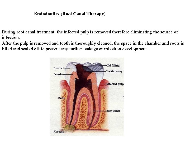 Endodontics (Root Canal Therapy) During root canal treatment: the infected pulp is removed therefore