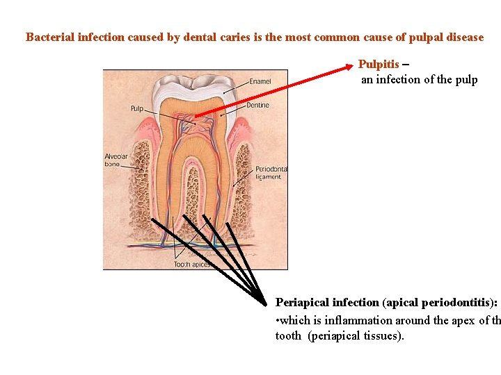 Bacterial infection caused by dental caries is the most common cause of pulpal disease