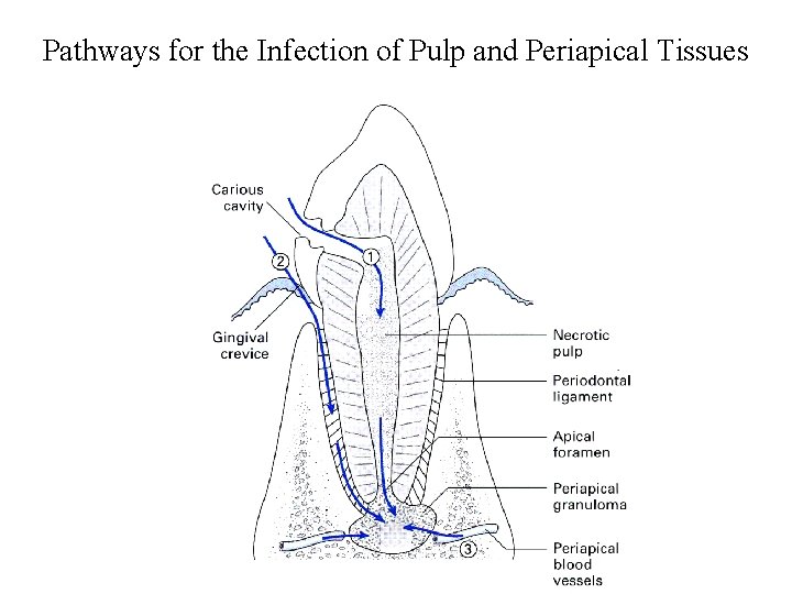Pathways for the Infection of Pulp and Periapical Tissues 