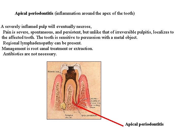 Apical periodontitis (inflammation around the apex of the tooth) A severely inflamed pulp will