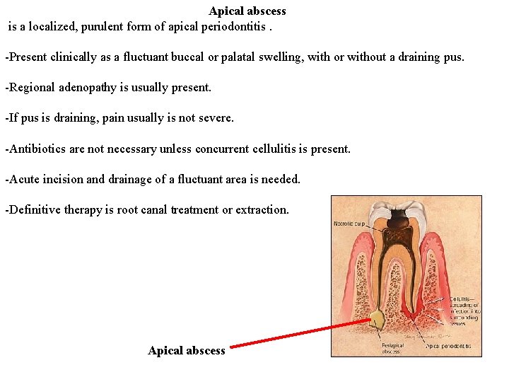 Apical abscess is a localized, purulent form of apical periodontitis. -Present clinically as a