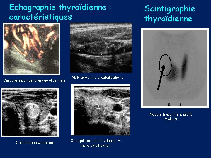 Echographie thyroïdienne : caractéristiques Vascularisation périphérique et centrale Scintigraphie thyroïdienne ADP avec micro calcifications