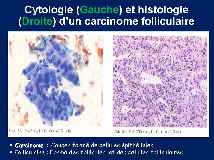 Cytologie (Gauche) et histologie (Droite) d’un carcinome folliculaire § Carcinome : Cancer formé de