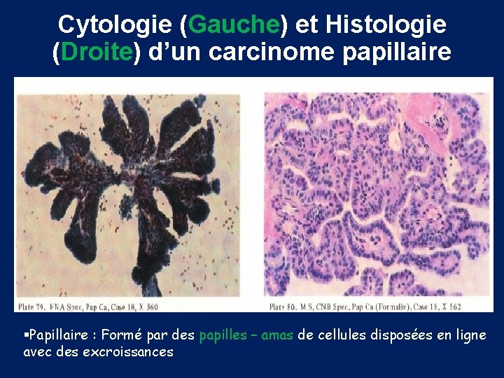 Cytologie (Gauche) et Histologie (Droite) d’un carcinome papillaire §Papillaire : Formé par des papilles