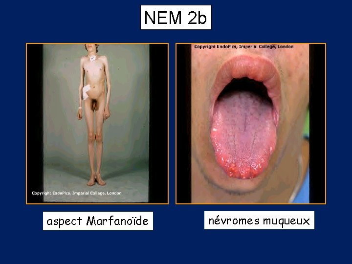 NEM 2 b aspect Marfanoïde névromes muqueux 