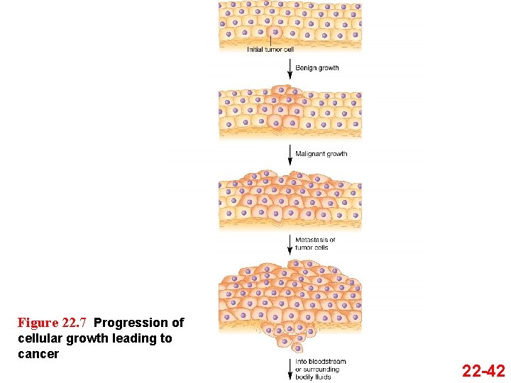 Figure 22. 7 Progression of cellular growth leading to cancer 22 -42 