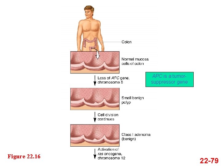 APC is a tumorsuppressor gene Figure 22. 16 22 -79 