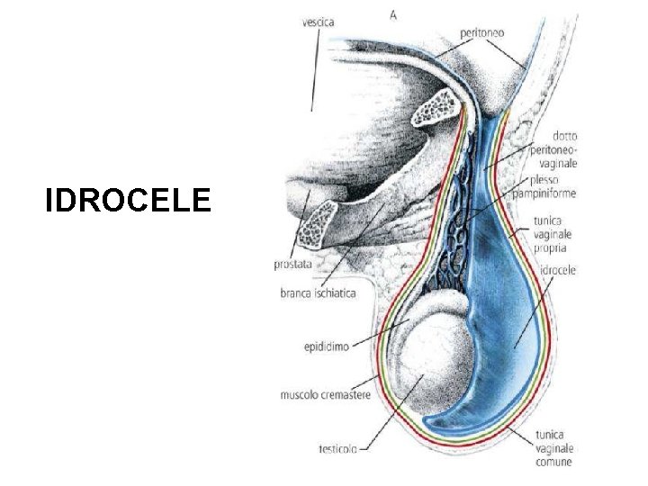 IDROCELE 