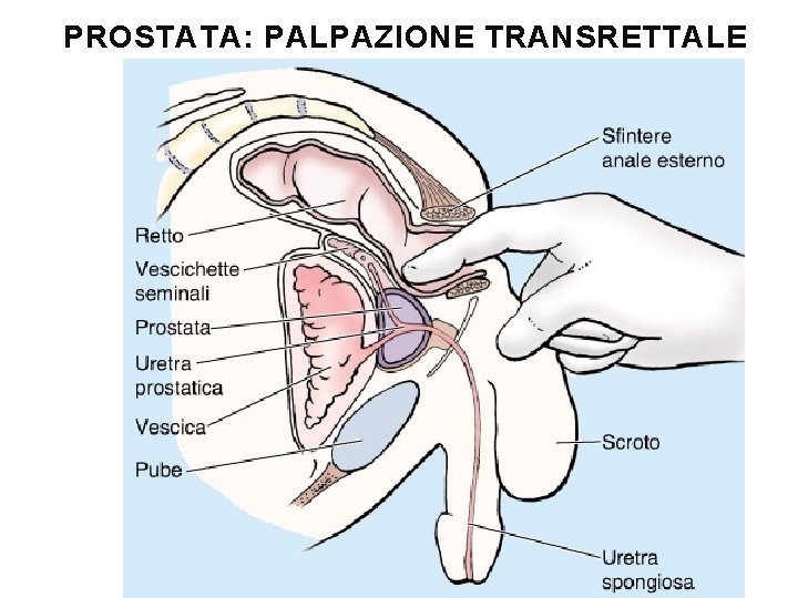 PROSTATA: PALPAZIONE TRANSRETTALE 