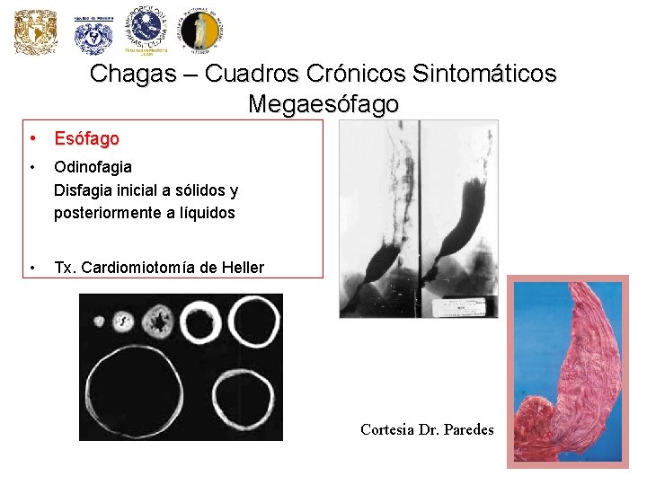 Chagas – Cuadros Crónicos Sintomáticos Megaesófago • Esófago • Odinofagia Disfagia inicial a sólidos