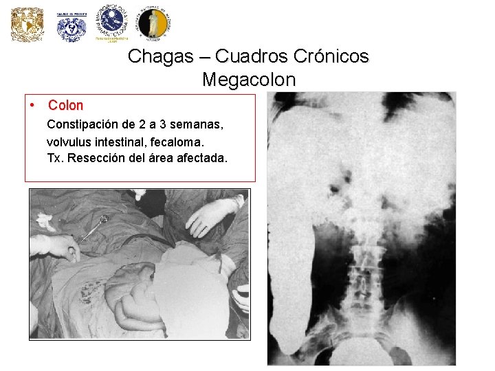 Chagas – Cuadros Crónicos Megacolon • Colon Constipación de 2 a 3 semanas, volvulus
