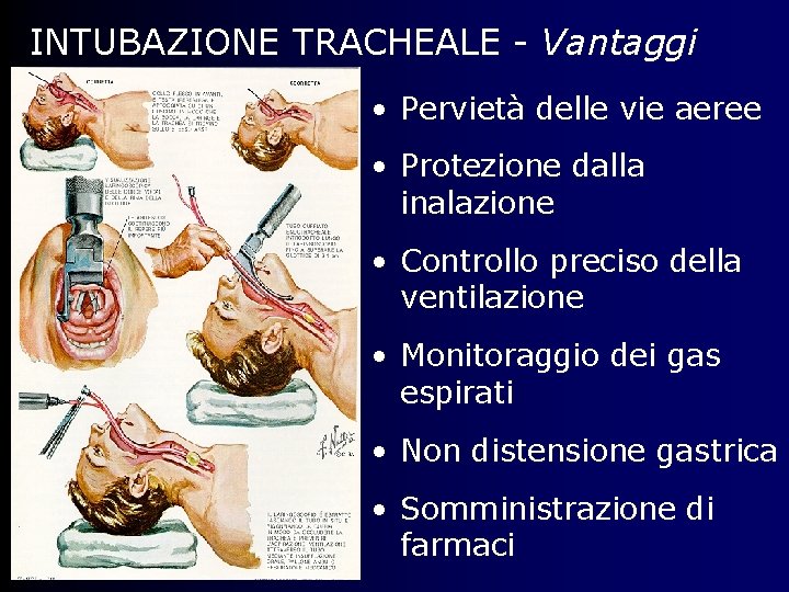 INTUBAZIONE TRACHEALE - Vantaggi • Pervietà delle vie aeree • Protezione dalla inalazione •