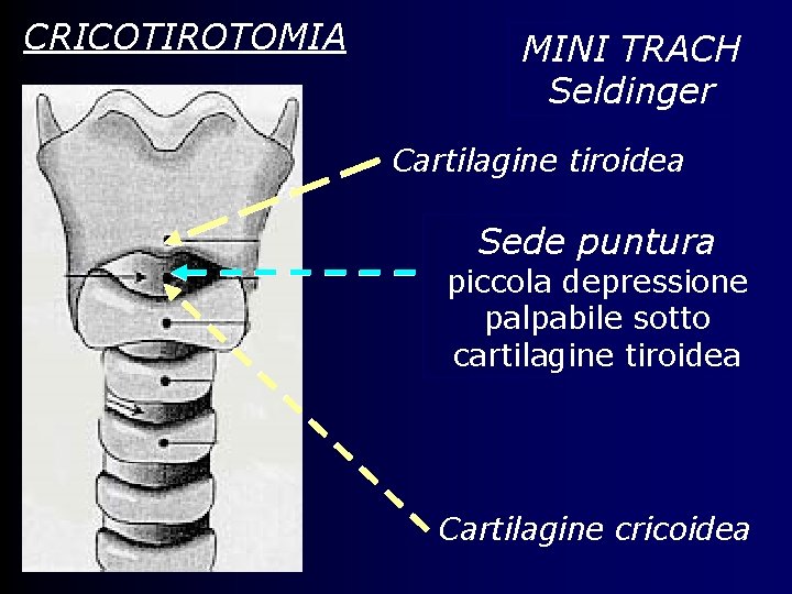 CRICOTIROTOMIA MINI TRACH Seldinger Cartilagine tiroidea Sede puntura piccola depressione palpabile sotto cartilagine tiroidea