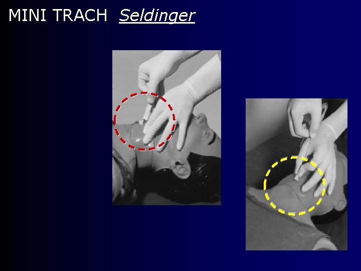 MINI TRACH Seldinger 