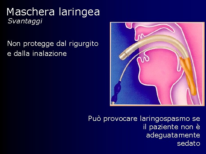 Maschera laringea Svantaggi Non protegge dal rigurgito e dalla inalazione Può provocare laringospasmo se