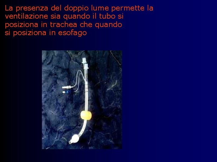 La presenza del doppio lume permette la ventilazione sia quando il tubo si posiziona