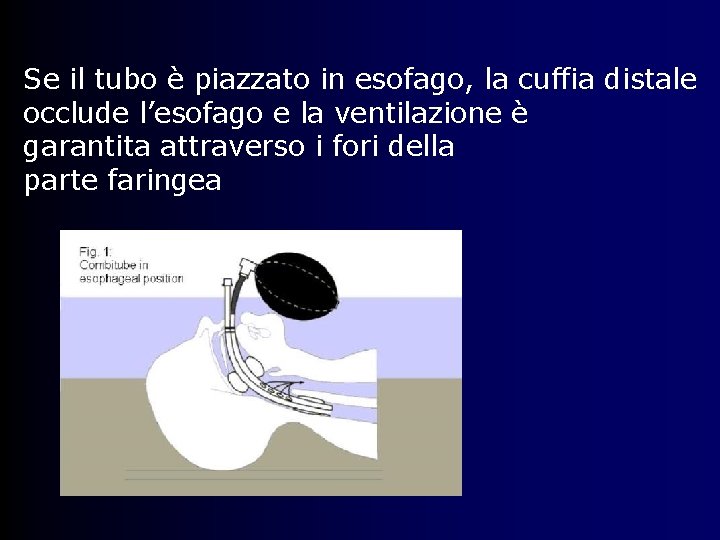 Se il tubo è piazzato in esofago, la cuffia distale occlude l’esofago e la