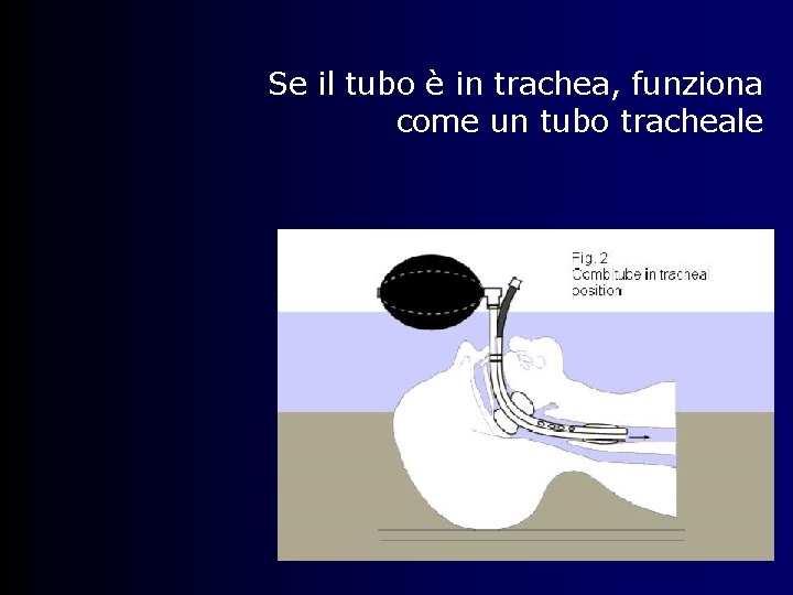 Se il tubo è in trachea, funziona come un tubo tracheale 