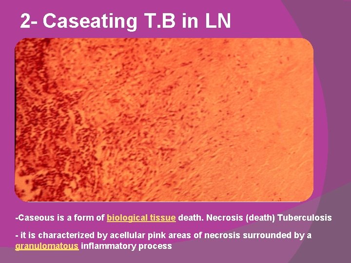 2 - Caseating T. B in LN -Caseous is a form of biological tissue