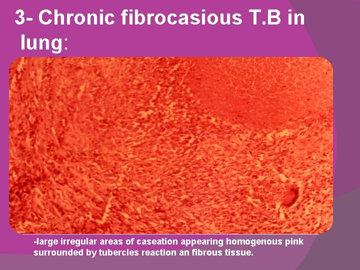 3 - Chronic fibrocasious T. B in lung: -large irregular areas of caseation appearing