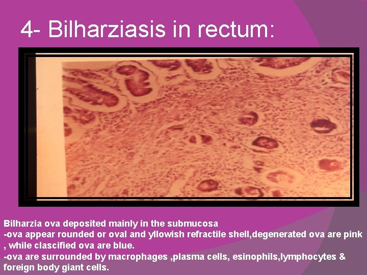 4 - Bilharziasis in rectum: Bilharzia ova deposited mainly in the submucosa -ova appear
