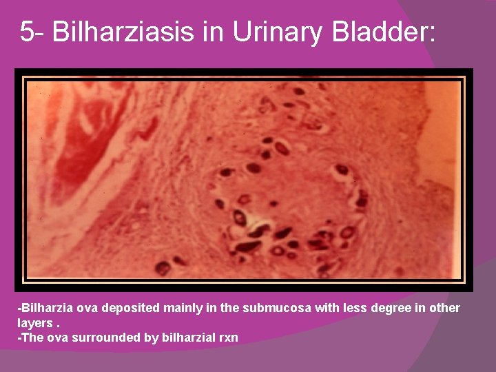 5 - Bilharziasis in Urinary Bladder: -Bilharzia ova deposited mainly in the submucosa with