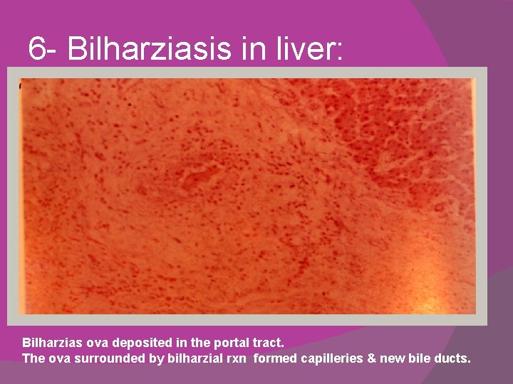 6 - Bilharziasis in liver: Bilharzias ova deposited in the portal tract. The ova