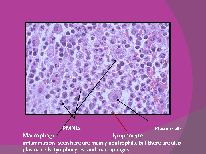 Macrophage PMNLs Plasma cells lymphocyte inflammation: seen here are mainly neutrophils, but there also