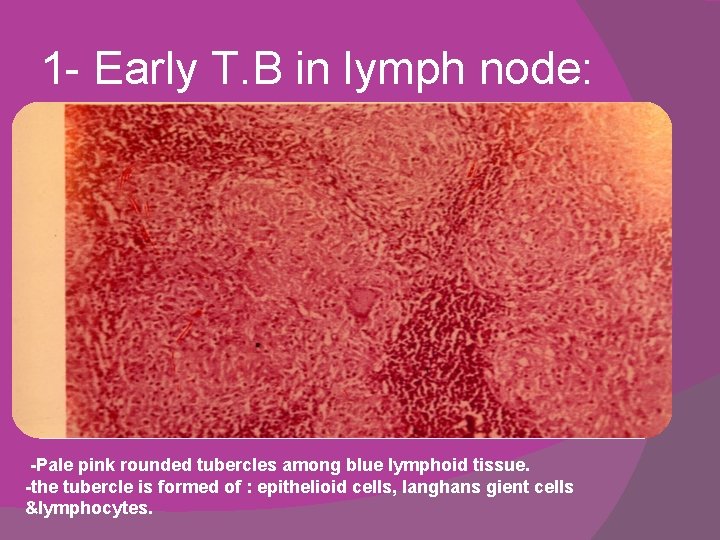 1 - Early T. B in lymph node: -Pale pink rounded tubercles among blue