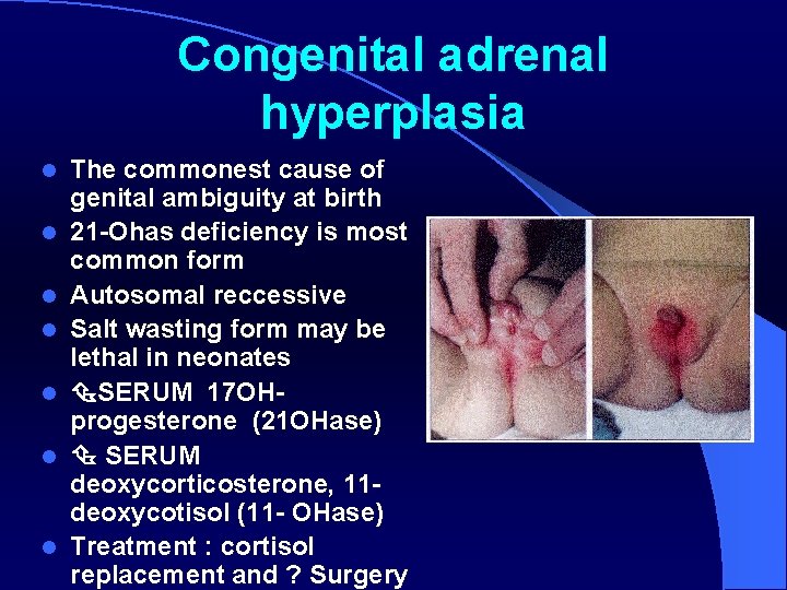 Congenital adrenal hyperplasia l l l l The commonest cause of genital ambiguity at