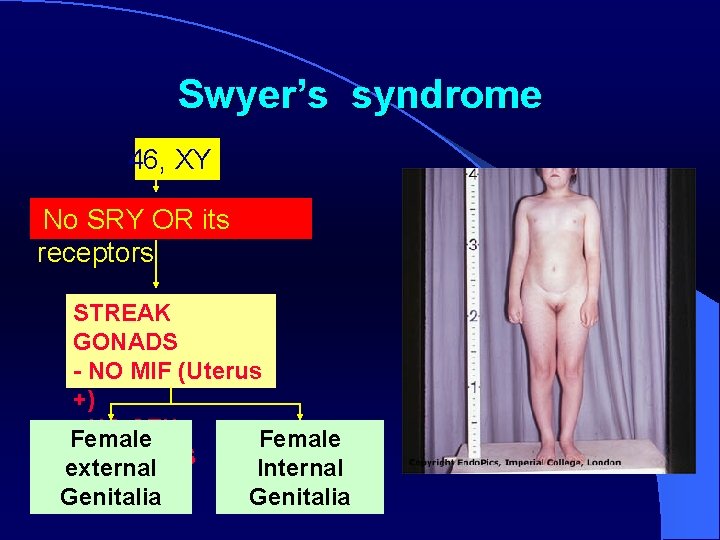 Swyer’s syndrome 46, XY No SRY OR its receptors STREAK GONADS - NO MIF