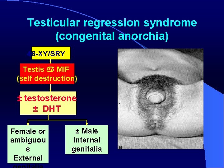 Testicular regression syndrome (congenital anorchia) 46 -XY/SRY Testis MIF (self destruction) ± testosterone ±