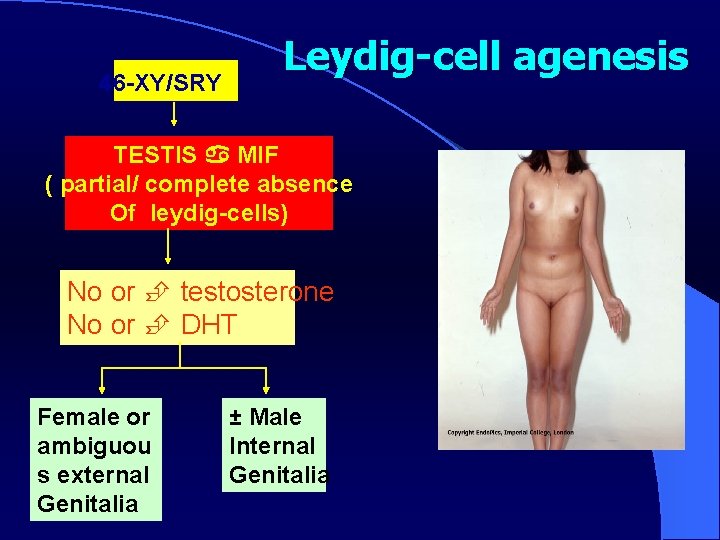 46 -XY/SRY Leydig-cell agenesis TESTIS MIF ( partial/ complete absence Of leydig-cells) No or