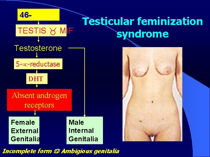 46 XY/SRY TESTIS MIF Testicular feminization syndrome Testosterone 5 - -reductase DHT Absent androgen