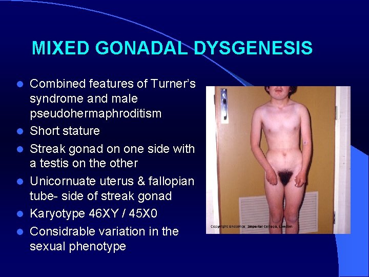 MIXED GONADAL DYSGENESIS l l l Combined features of Turner’s syndrome and male pseudohermaphroditism